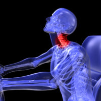 skeleton with Whiplash Injury skeleton with Whiplash Injury